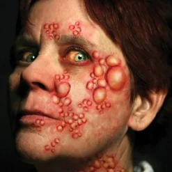 Tatovering, Diseased